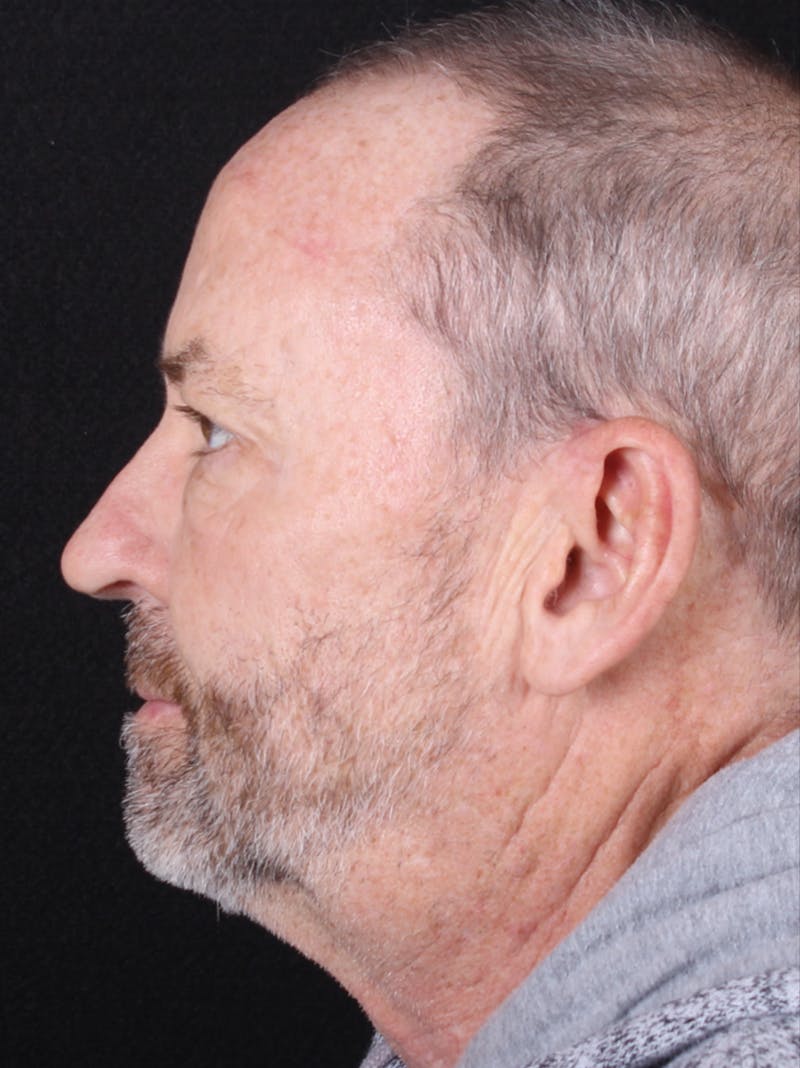 Rhinoplasty Male Before & After Gallery - Patient 109349 - Image 7