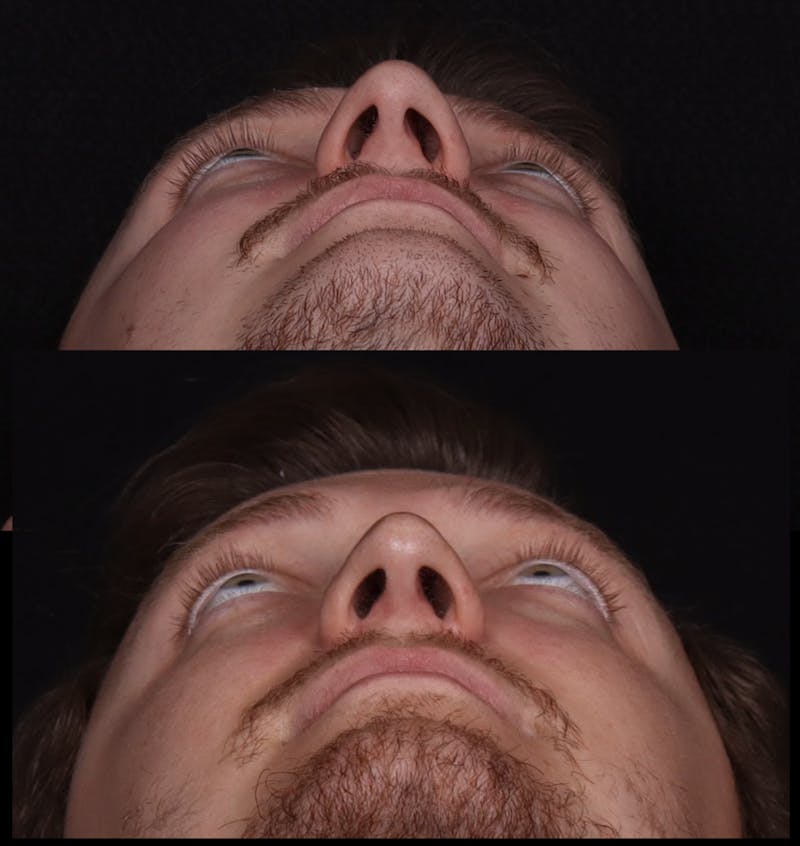 Rhinoplasty Male Before & After Gallery - Patient 405017 - Image 9