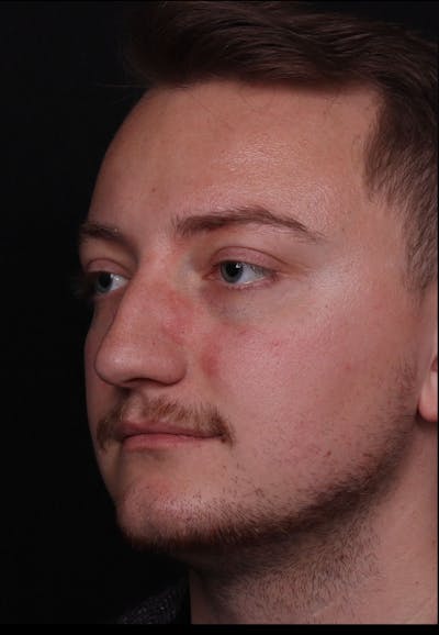 Rhinoplasty Male Before & After Gallery - Patient 405017 - Image 1