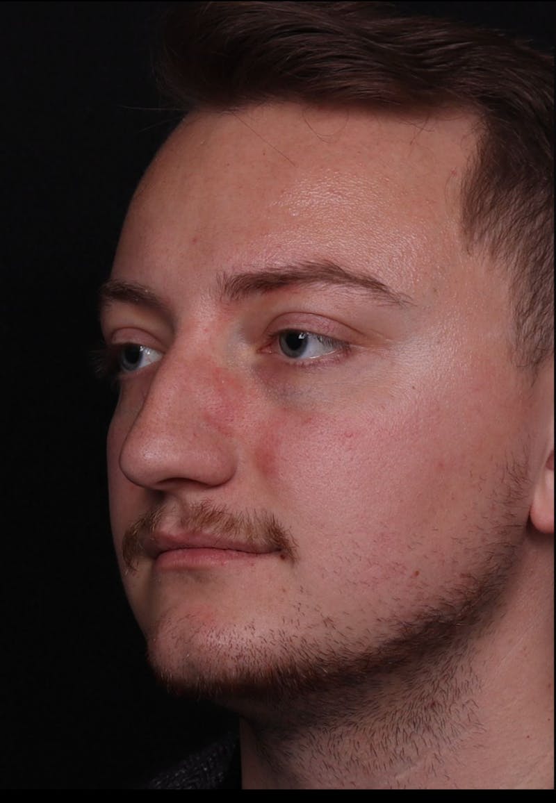 Rhinoplasty Male Before & After Gallery - Patient 405017 - Image 1
