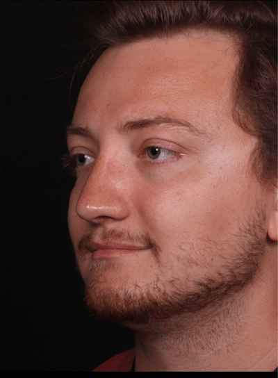 Rhinoplasty Male Before & After Gallery - Patient 405017 - Image 2