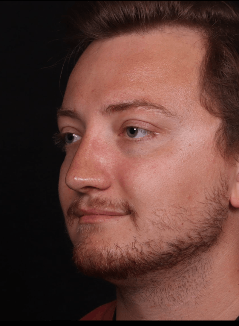 Rhinoplasty Male Before & After Gallery - Patient 405017 - Image 2