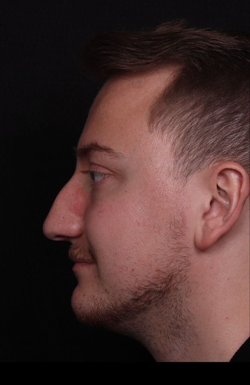 Rhinoplasty Male Before & After Gallery - Patient 405017 - Image 7