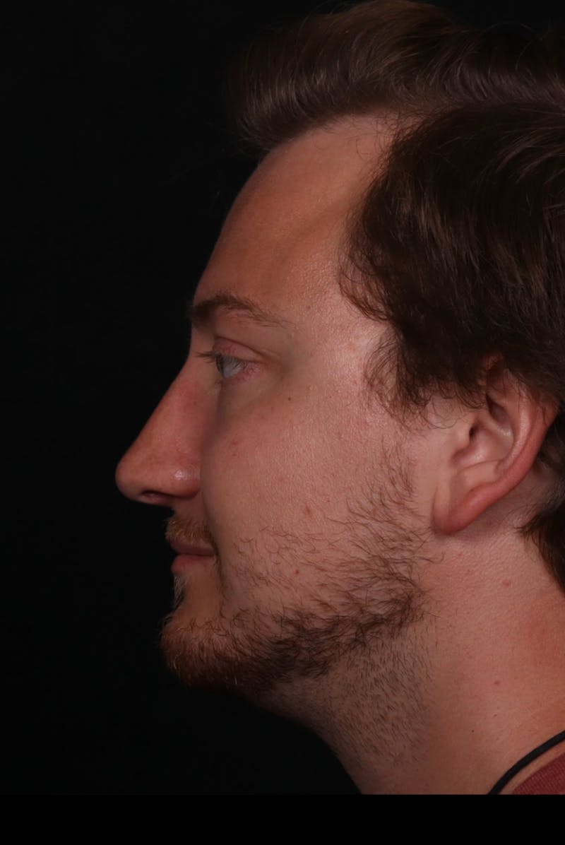 Rhinoplasty Male Before & After Gallery - Patient 405017 - Image 8