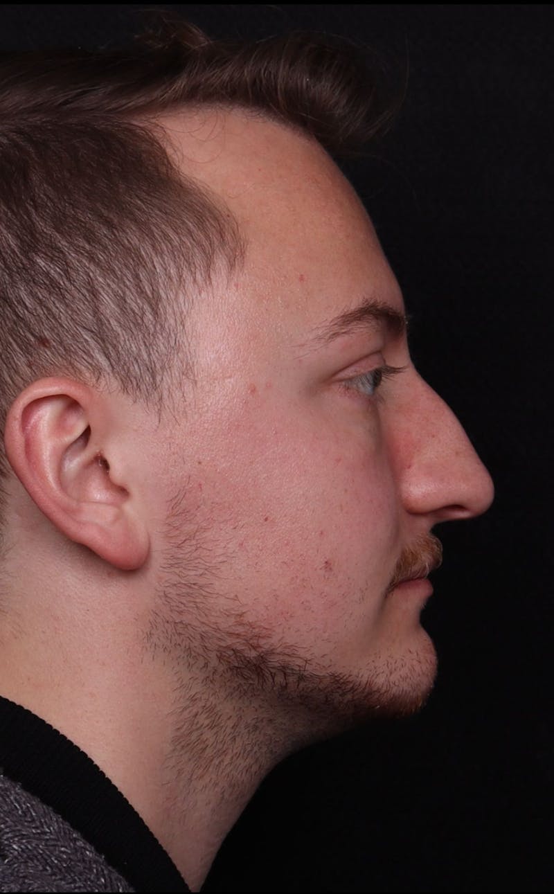 Rhinoplasty Male Before & After Gallery - Patient 405017 - Image 5