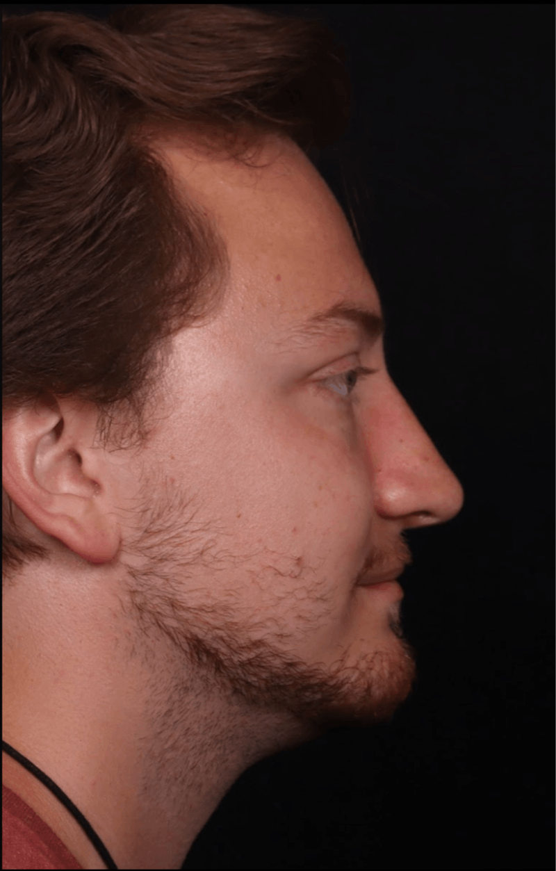 Rhinoplasty Male Before & After Gallery - Patient 405017 - Image 6