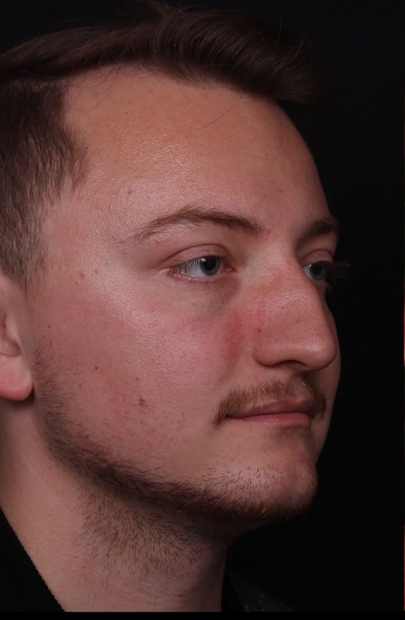 Rhinoplasty Male Before & After Gallery - Patient 405017 - Image 3