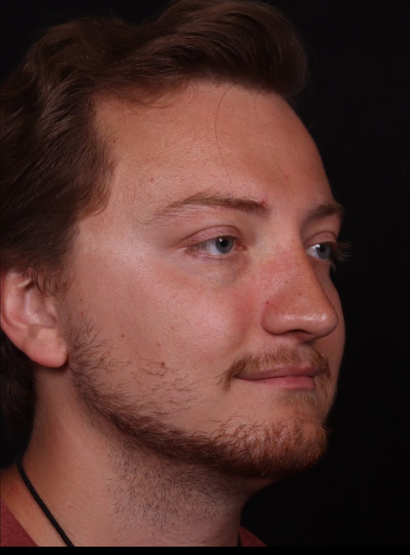 Rhinoplasty Male Before & After Gallery - Patient 405017 - Image 4