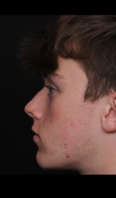 Rhinoplasty Male Before & After Gallery - Patient 391921 - Image 1