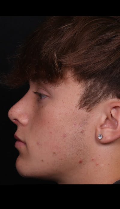 Rhinoplasty Male Before & After Gallery - Patient 391921 - Image 2