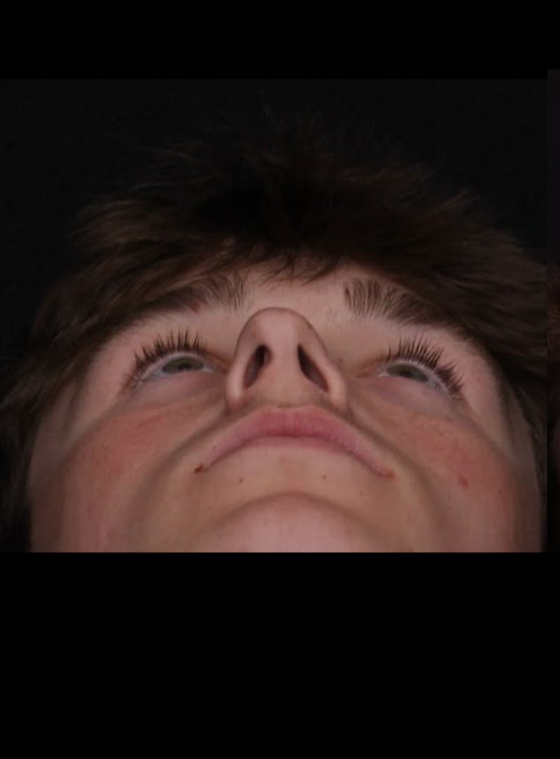 Rhinoplasty Male Before & After Gallery - Patient 391921 - Image 7