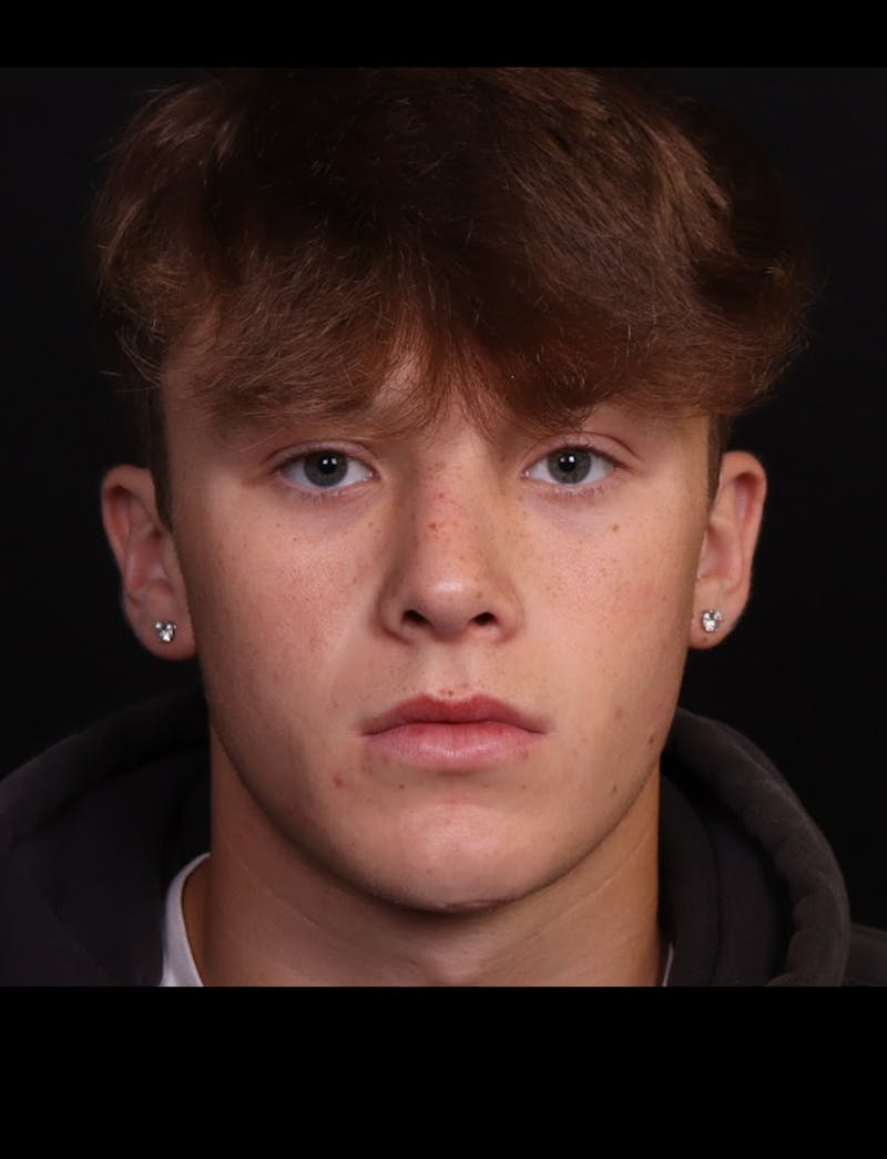 Rhinoplasty Male Before & After Gallery - Patient 391921 - Image 6