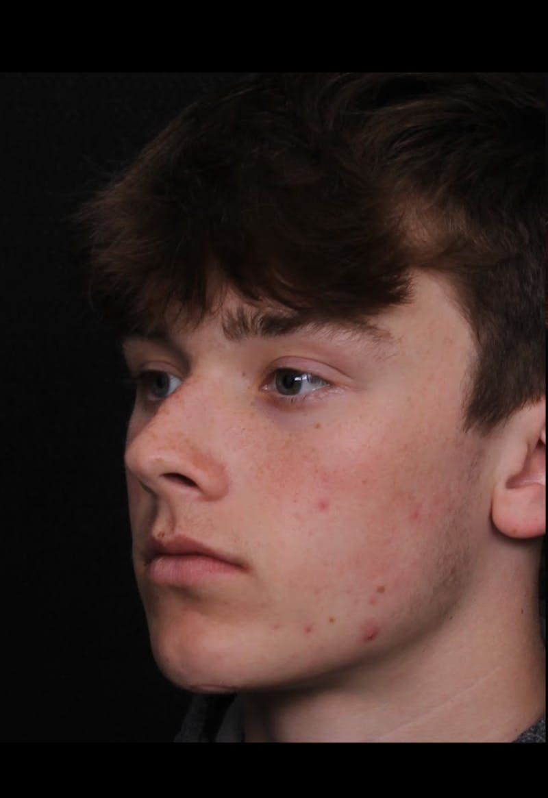 Rhinoplasty Male Before & After Gallery - Patient 391921 - Image 3