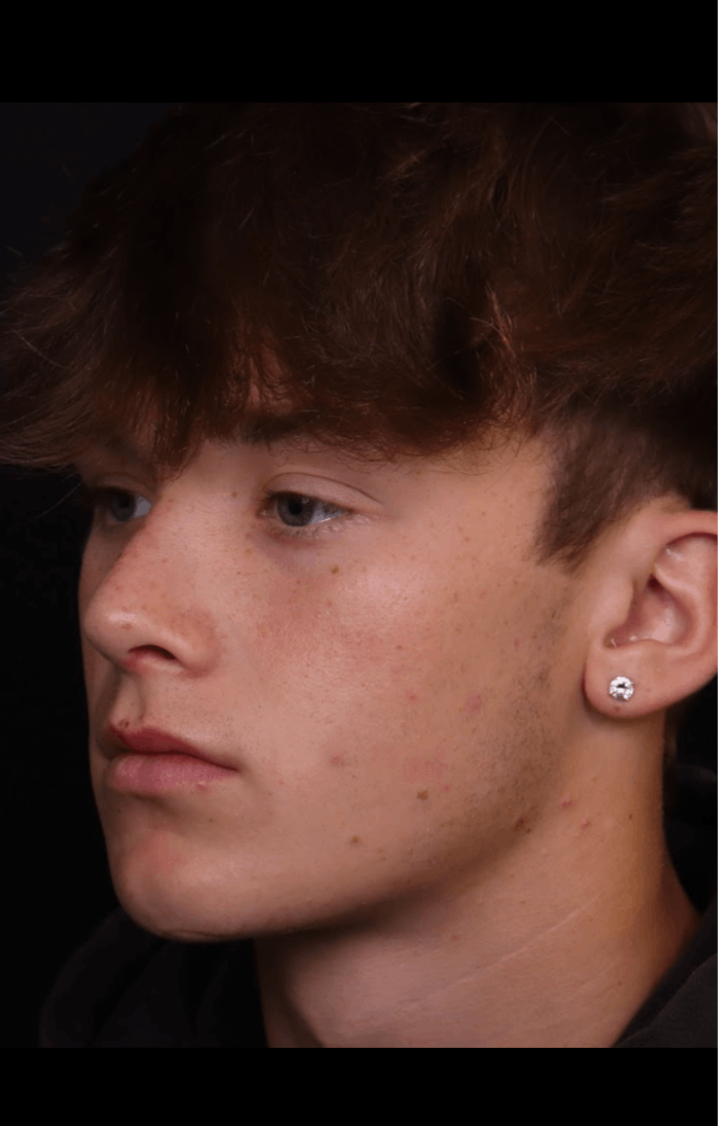 Rhinoplasty Male Before & After Gallery - Patient 391921 - Image 4