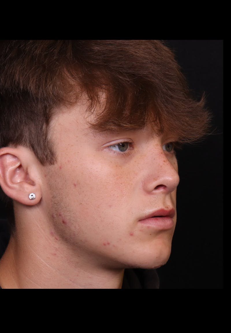 Rhinoplasty Male Before & After Gallery - Patient 391921 - Image 10