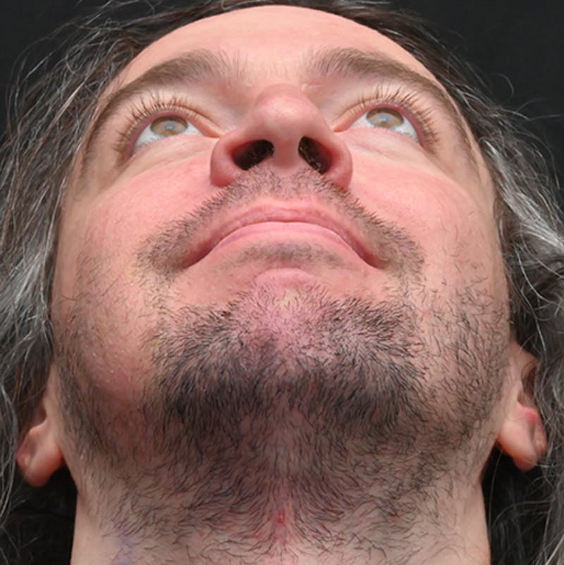 Facial Lesion/Keloid Removal Before & After Gallery - Patient 105343 - Image 4