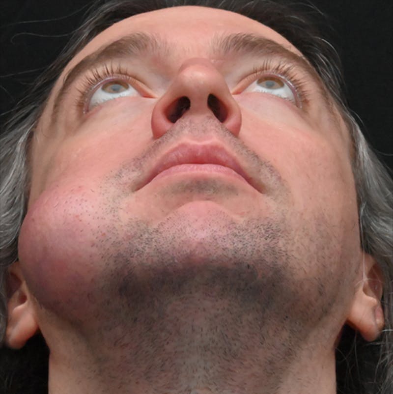 Facial Lesion/Keloid Removal Before & After Gallery - Patient 105343 - Image 3