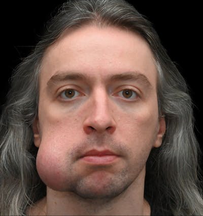 Facial Lesion/Keloid Removal Before & After Gallery - Patient 105343 - Image 1