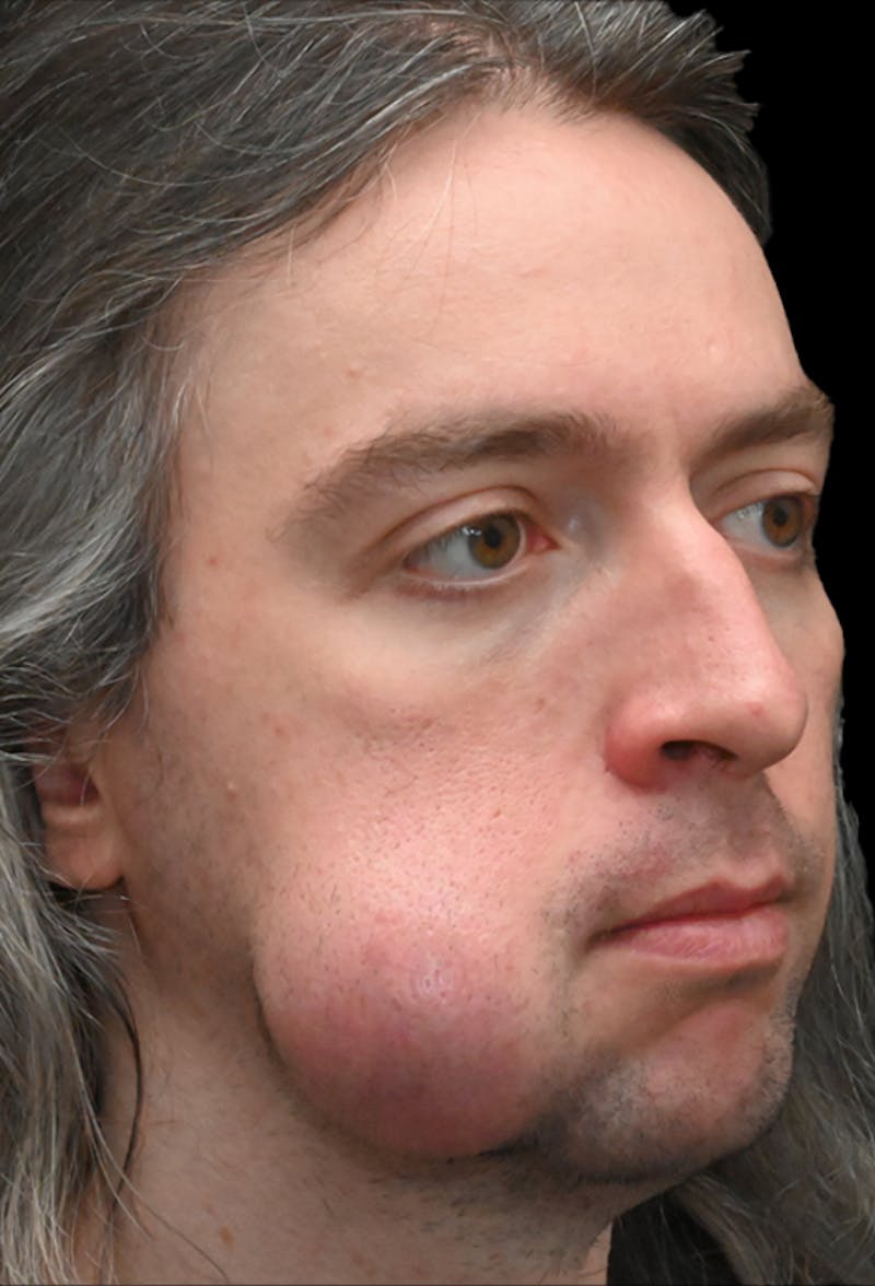 Facial Lesion/Keloid Removal Before & After Gallery - Patient 105343 - Image 5