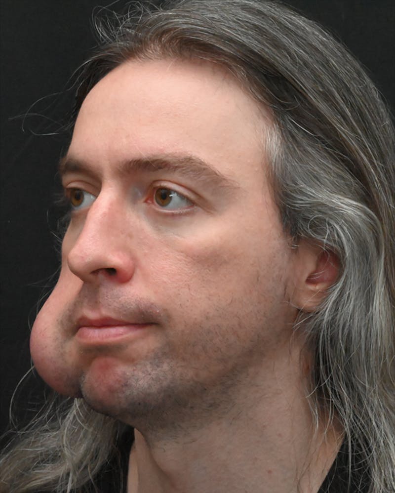 Facial Lesion/Keloid Removal Before & After Gallery - Patient 105343 - Image 7