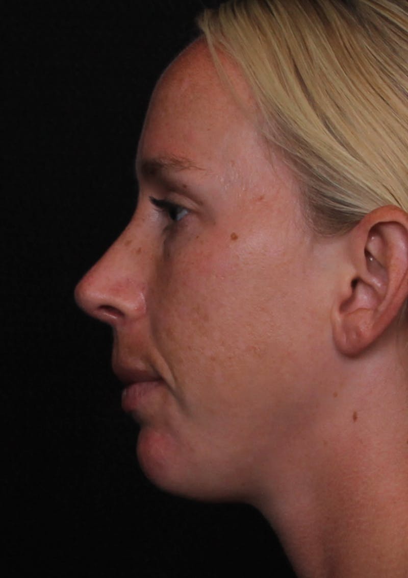 Rhinoplasty Female Before & After Gallery - Patient 356238 - Image 2