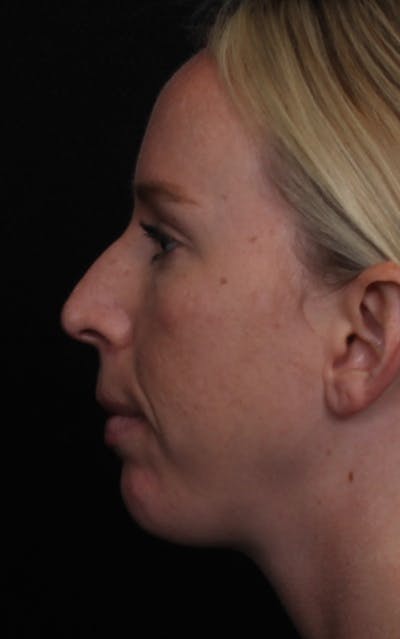 Rhinoplasty Female Before & After Gallery - Patient 356238 - Image 1