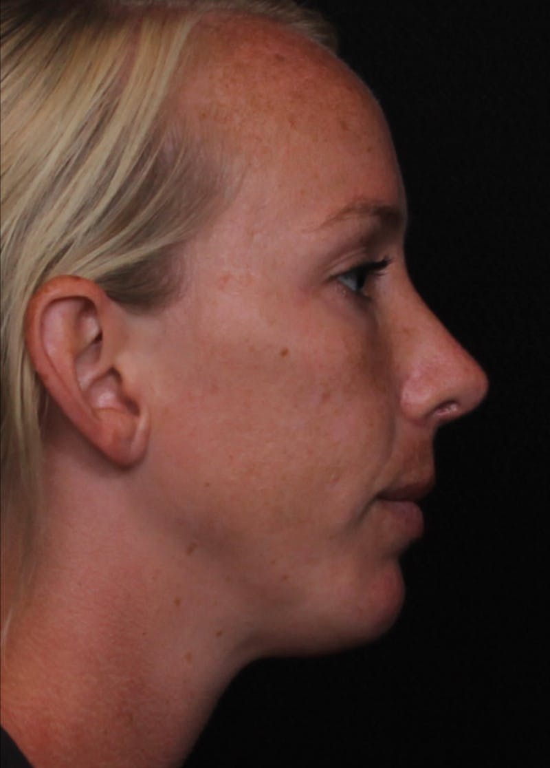 Rhinoplasty Female Before & After Gallery - Patient 356238 - Image 4