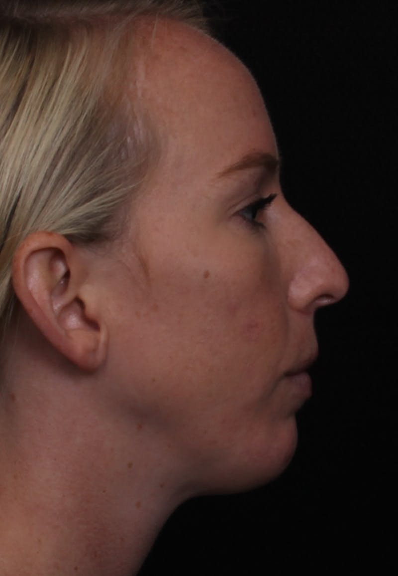 Rhinoplasty Female Before & After Gallery - Patient 356238 - Image 3