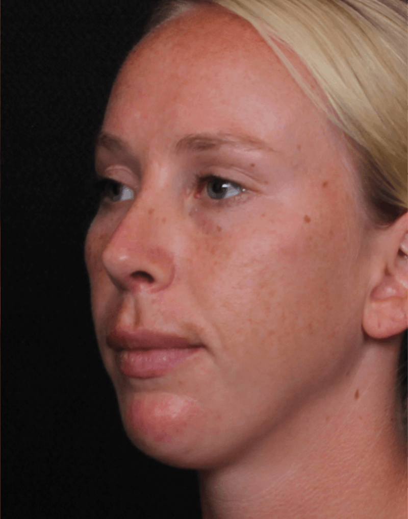 Rhinoplasty Female Before & After Gallery - Patient 356238 - Image 6