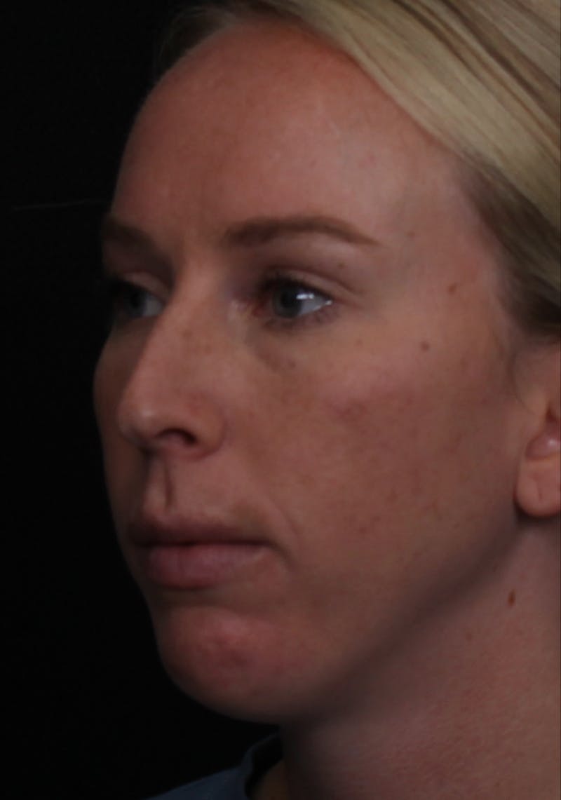 Rhinoplasty Female Before & After Gallery - Patient 356238 - Image 5