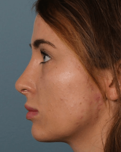 Rhinoplasty Female Before & After Gallery - Patient 278884 - Image 2