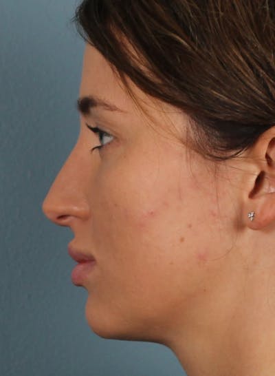 Rhinoplasty Female Before & After Gallery - Patient 278884 - Image 1