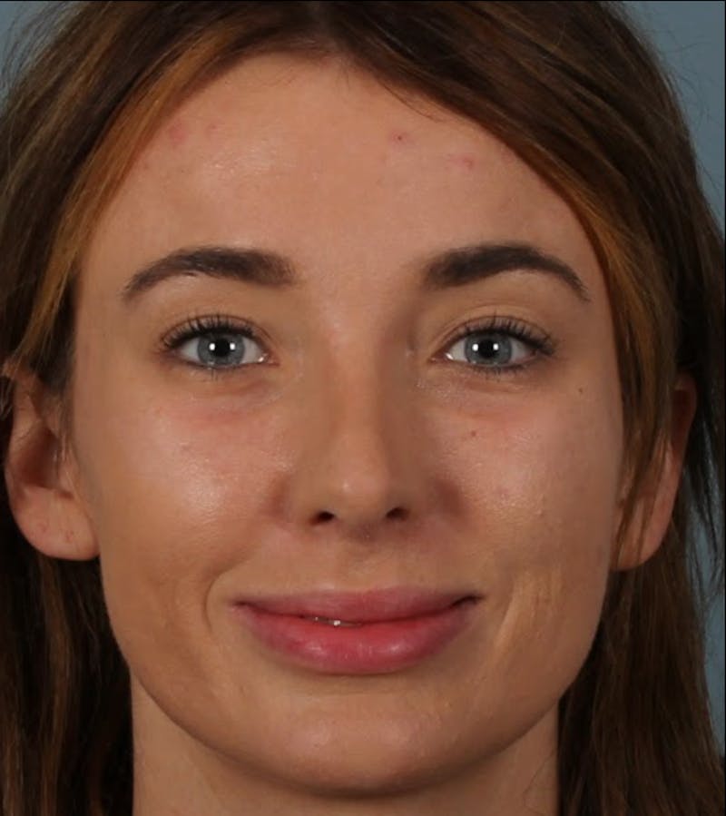 Rhinoplasty Female Before & After Gallery - Patient 278884 - Image 4