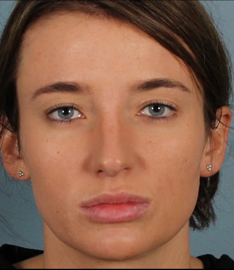 Rhinoplasty Female Before & After Gallery - Patient 278884 - Image 3