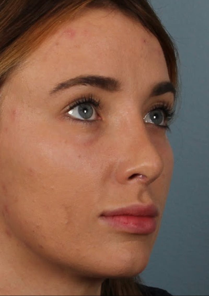 Rhinoplasty Female Before & After Gallery - Patient 278884 - Image 6