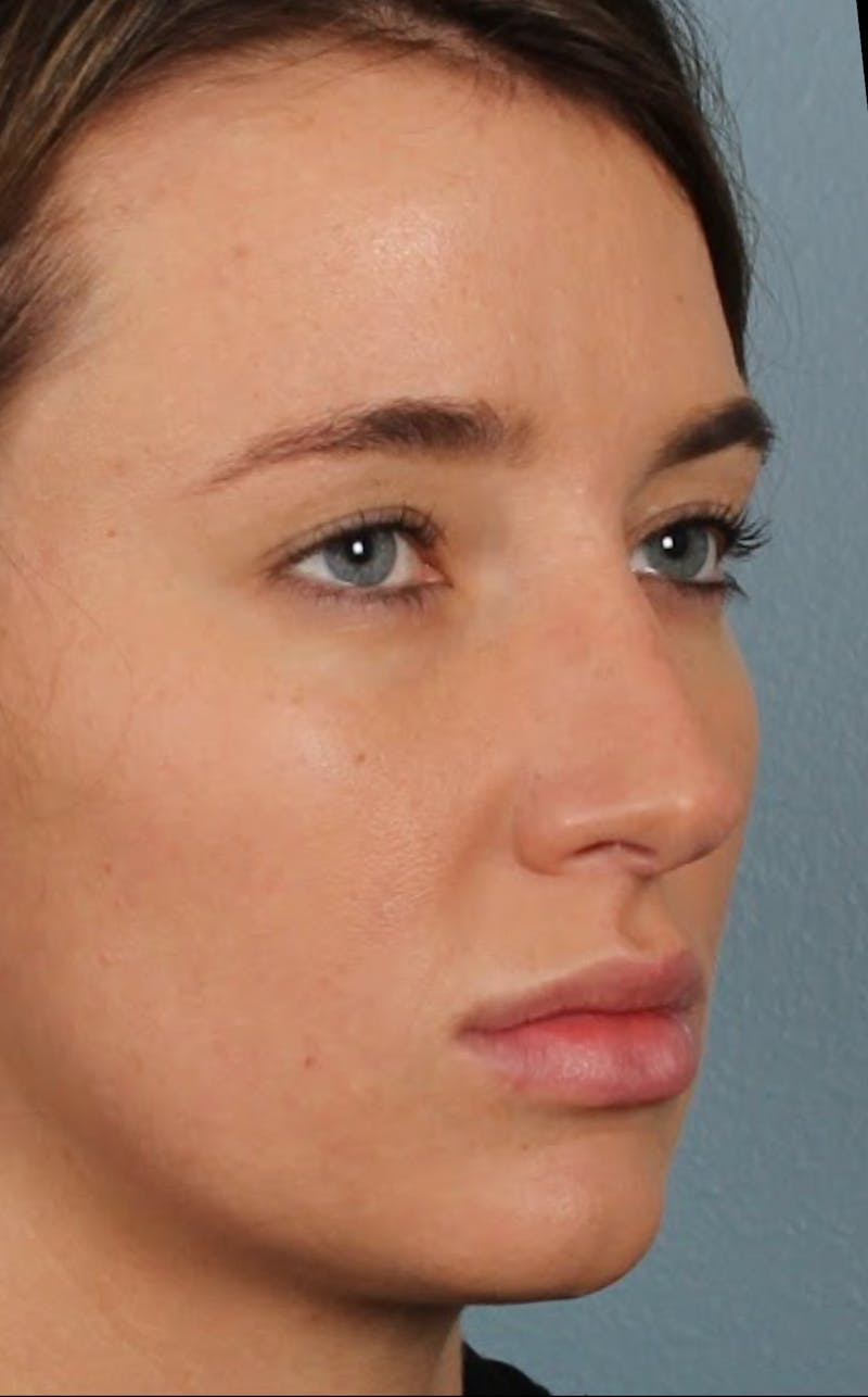 Rhinoplasty Female Before & After Gallery - Patient 278884 - Image 5