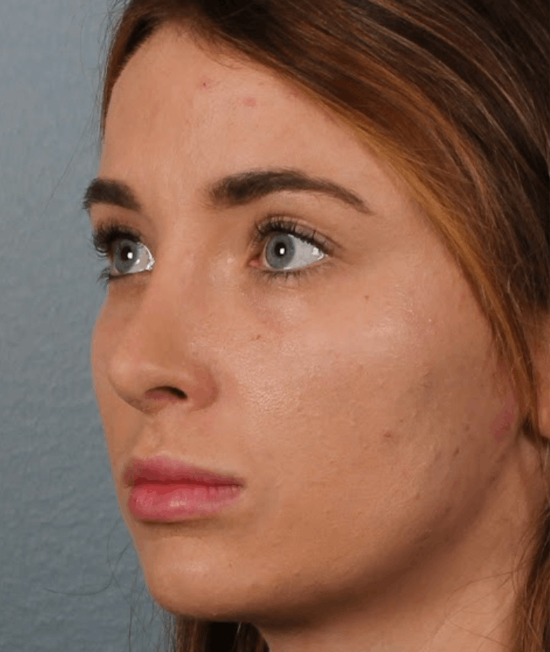 Rhinoplasty Female Before & After Gallery - Patient 278884 - Image 8