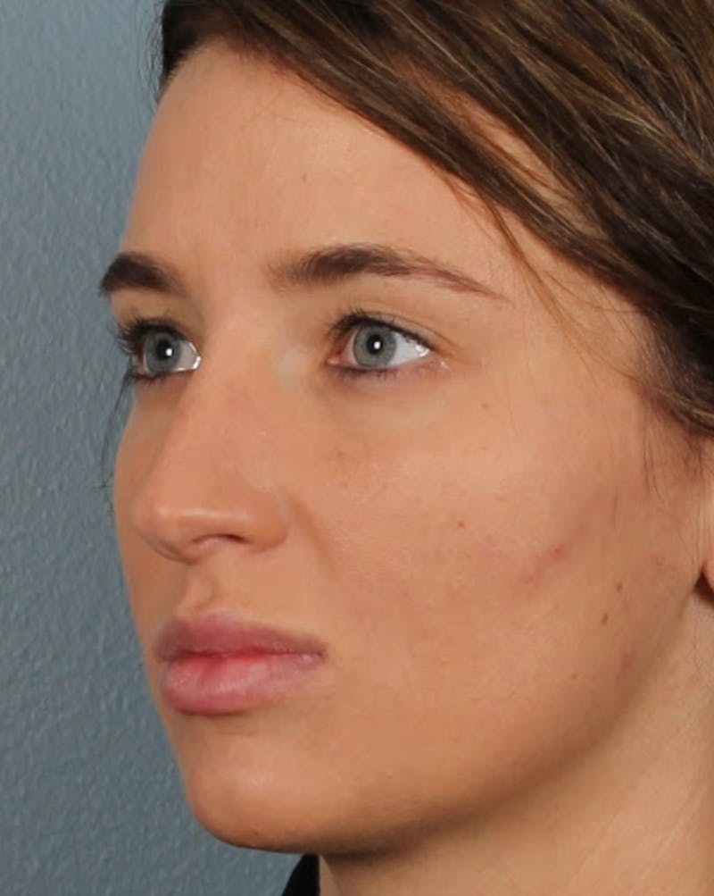 Rhinoplasty Female Before & After Gallery - Patient 278884 - Image 7