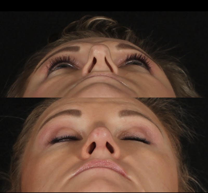 Rhinoplasty Female Before & After Gallery - Patient 277755 - Image 5