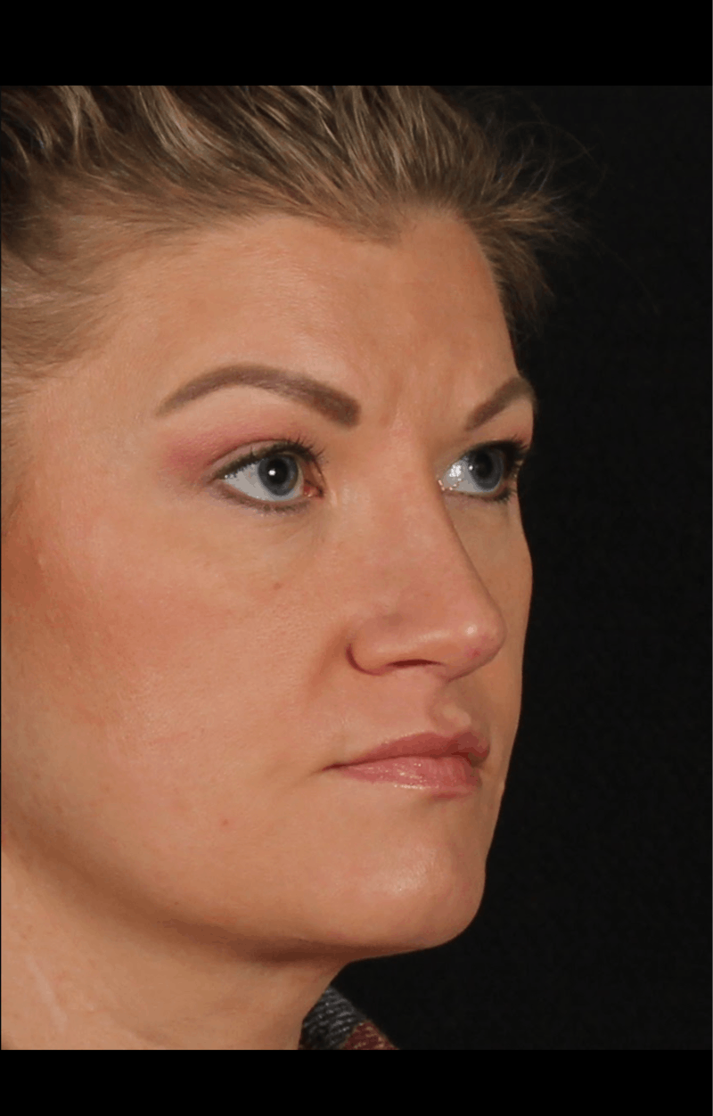 Rhinoplasty Female Before & After Gallery - Patient 277755 - Image 8
