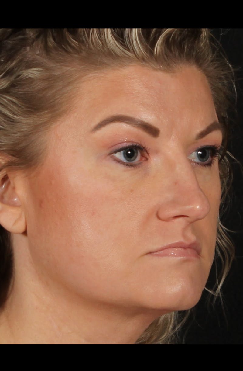 Rhinoplasty Female Before & After Gallery - Patient 277755 - Image 7