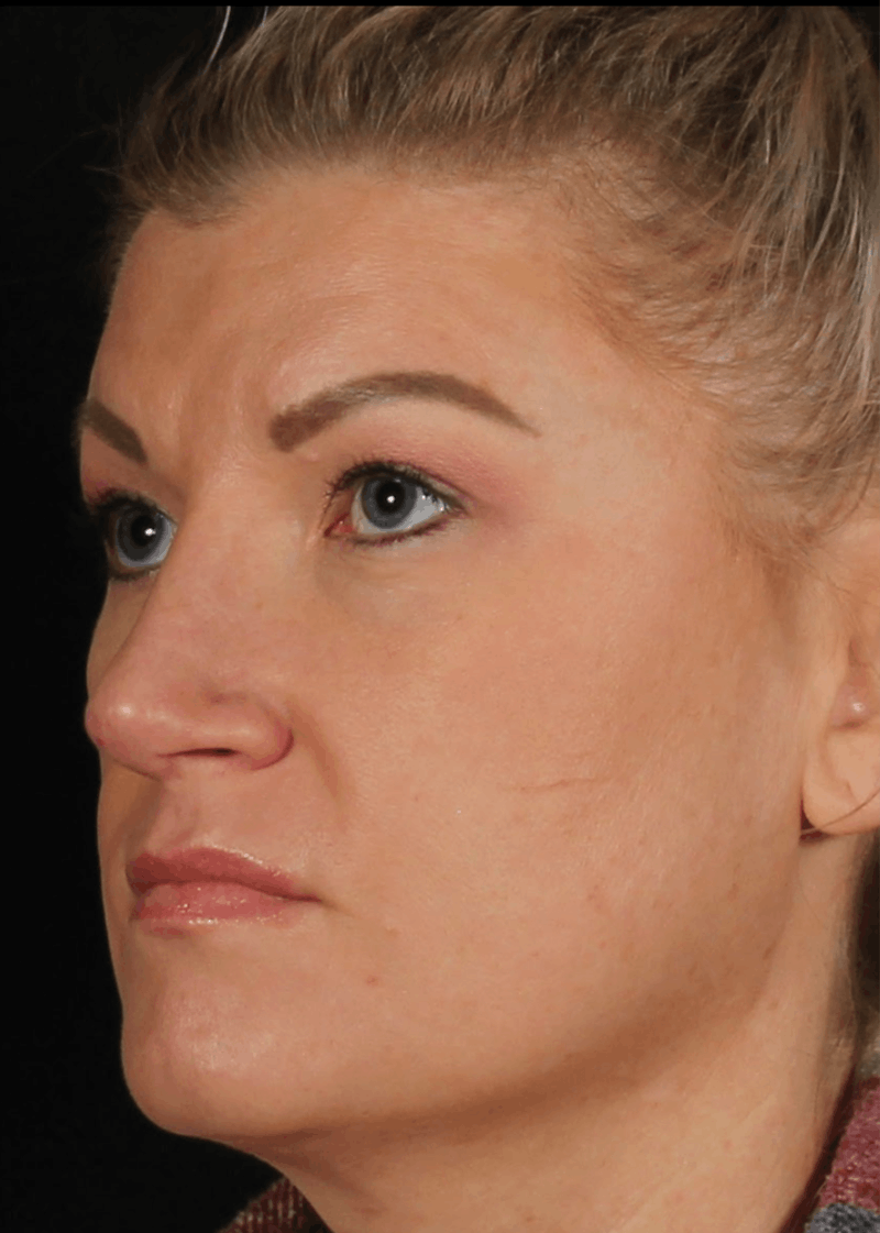 Rhinoplasty Female Before & After Gallery - Patient 277755 - Image 10