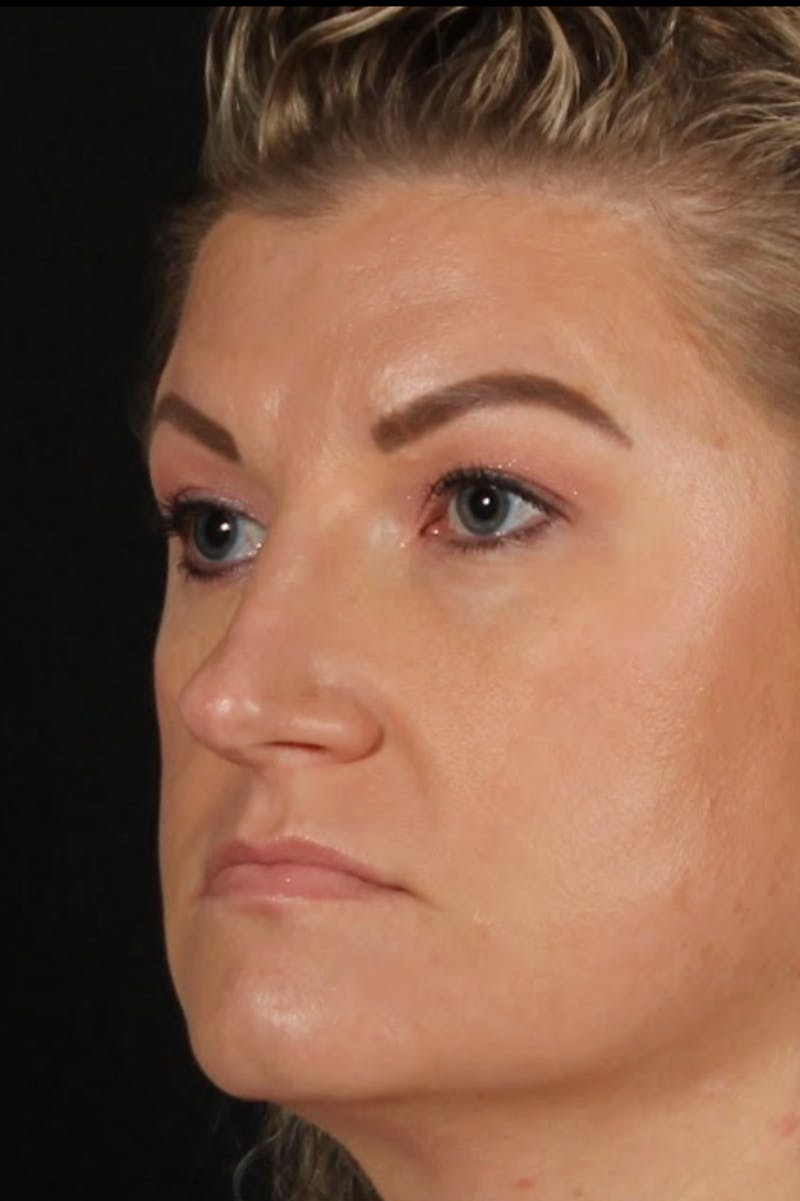 Rhinoplasty Female Before & After Gallery - Patient 277755 - Image 9