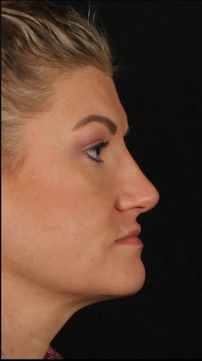 Rhinoplasty Female Before & After Gallery - Patient 277755 - Image 2