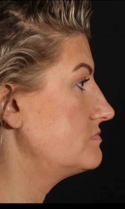 Rhinoplasty Female Before & After Gallery - Patient 277755 - Image 1