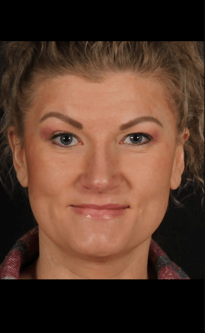 Rhinoplasty Female Before & After Gallery - Patient 277755 - Image 4