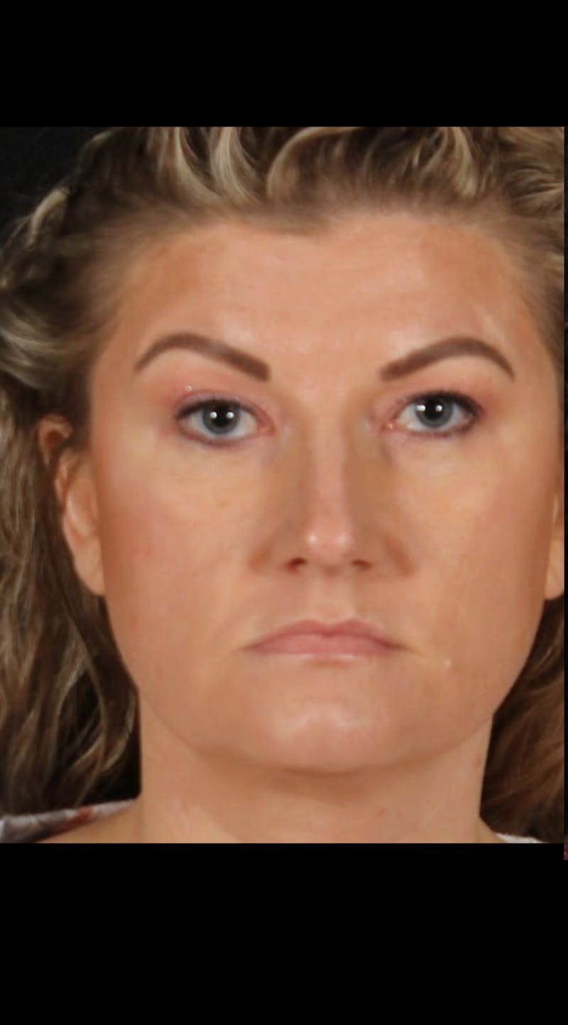 Rhinoplasty Female Before & After Gallery - Patient 277755 - Image 3