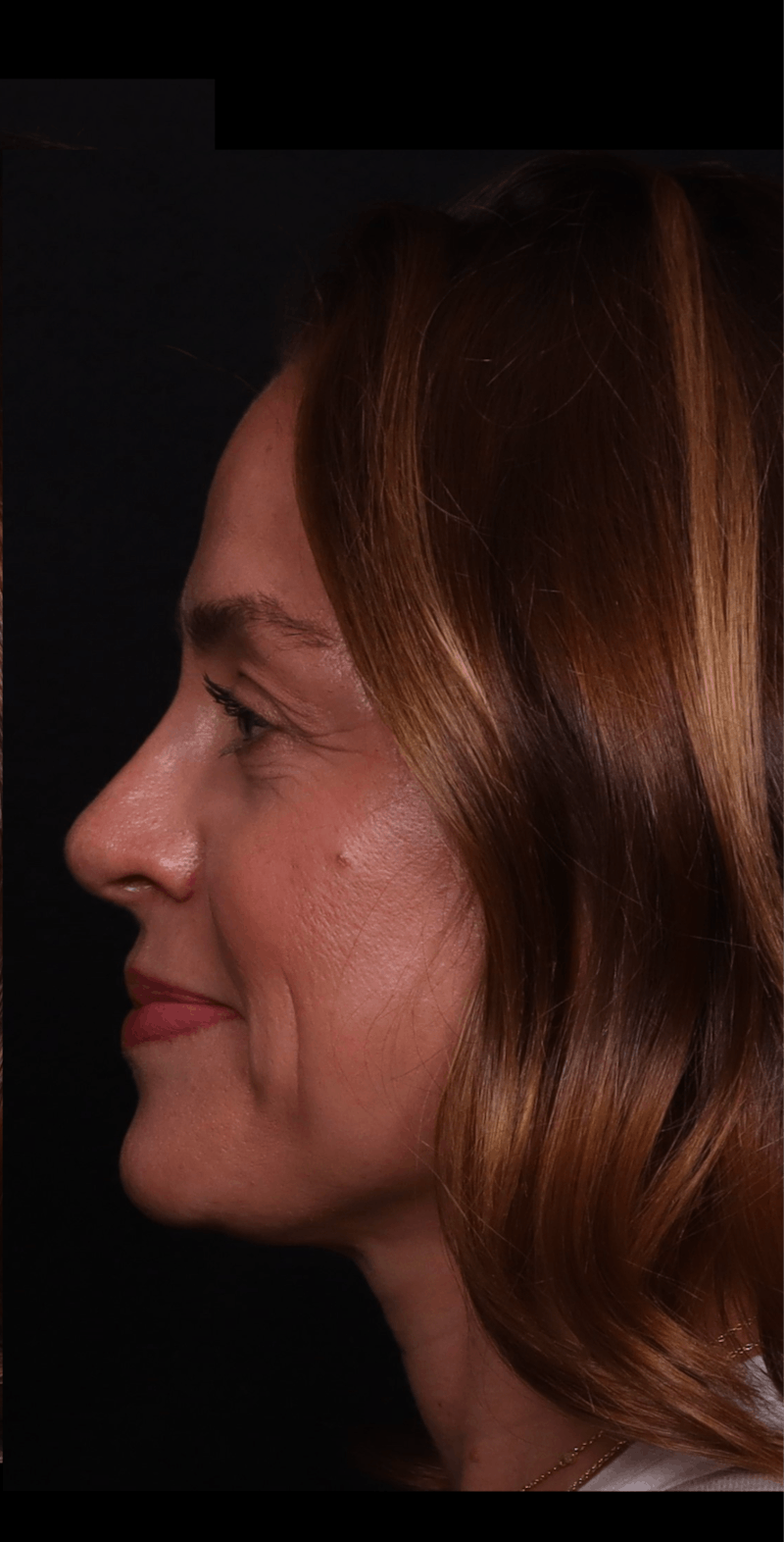 Rhinoplasty Female Before & After Gallery - Patient 236574 - Image 4