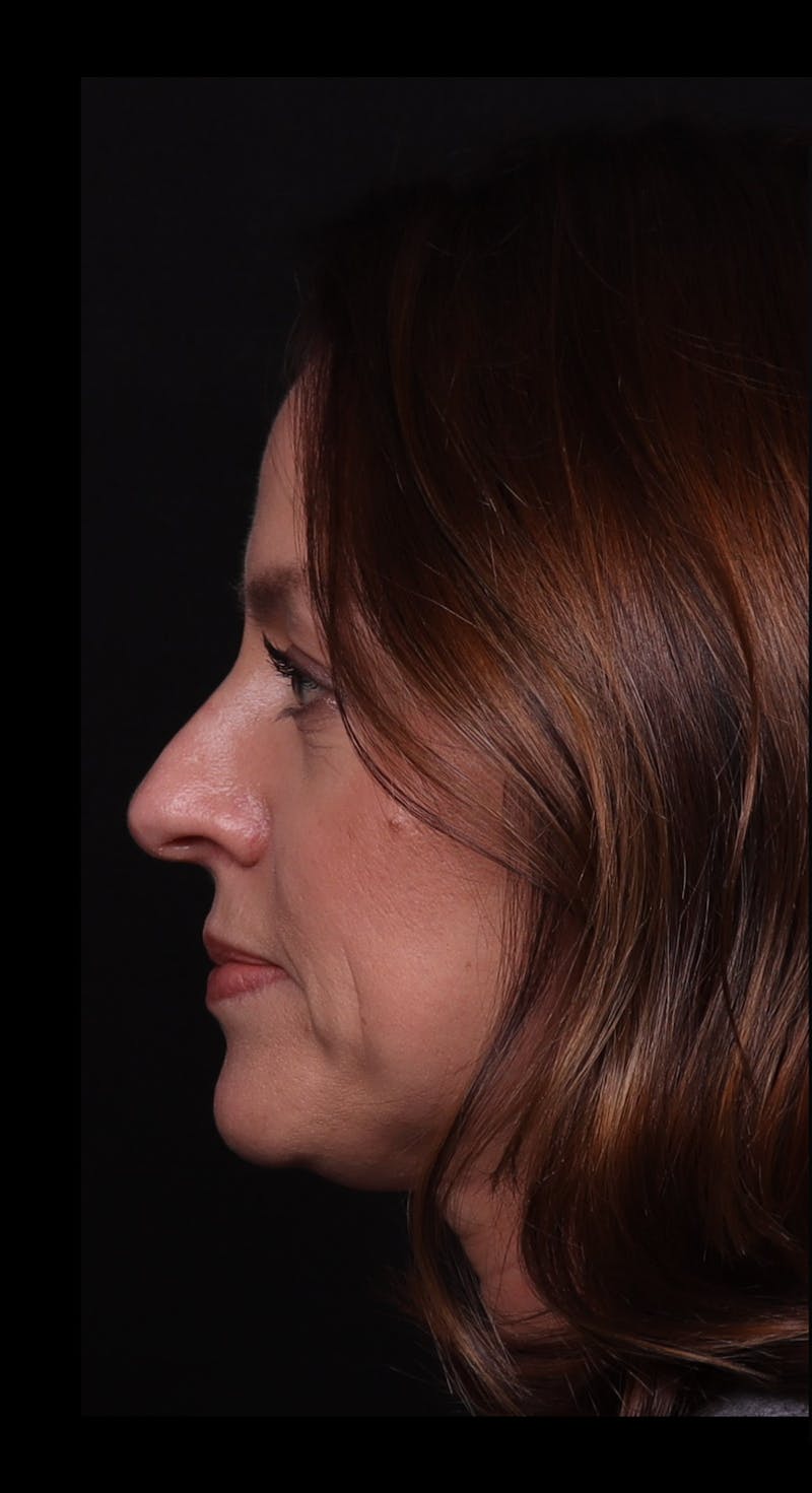 Rhinoplasty Female Before & After Gallery - Patient 236574 - Image 3