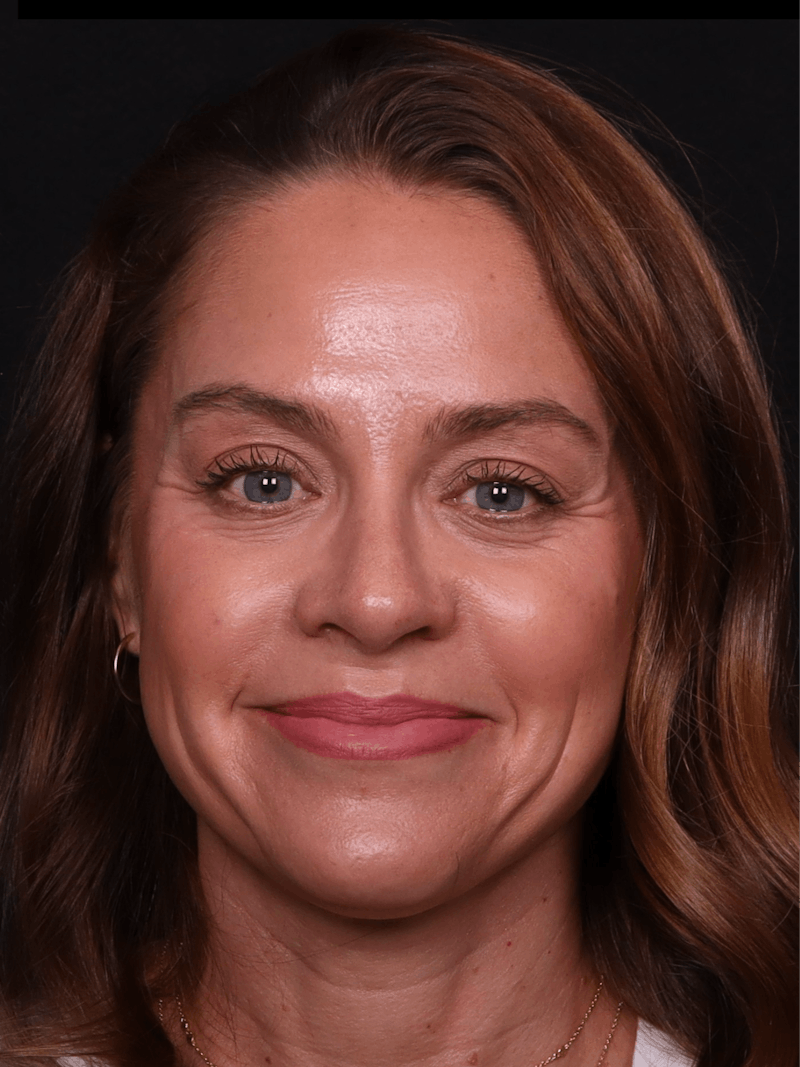 Rhinoplasty Female Before & After Gallery - Patient 236574 - Image 6